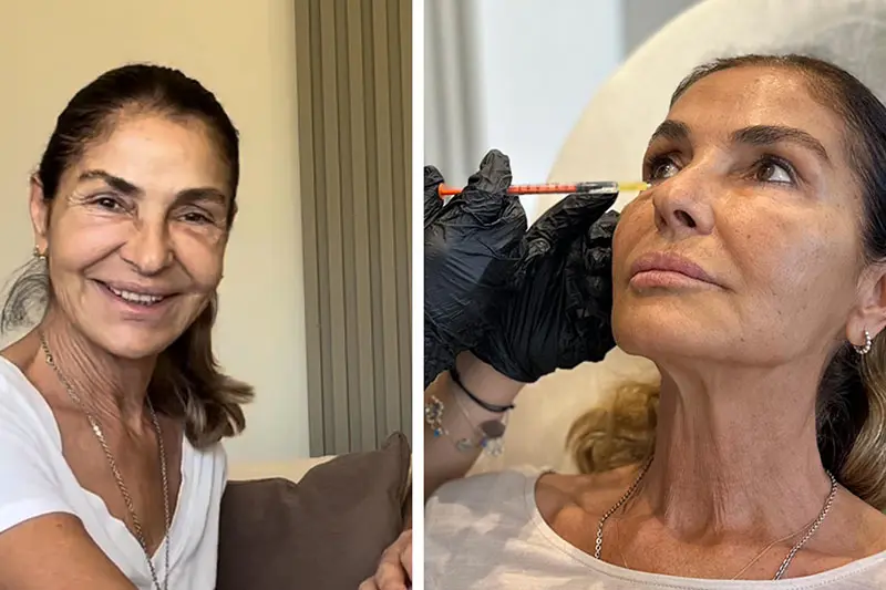 Derya Tuna Ameliyatsız Yüz Germe