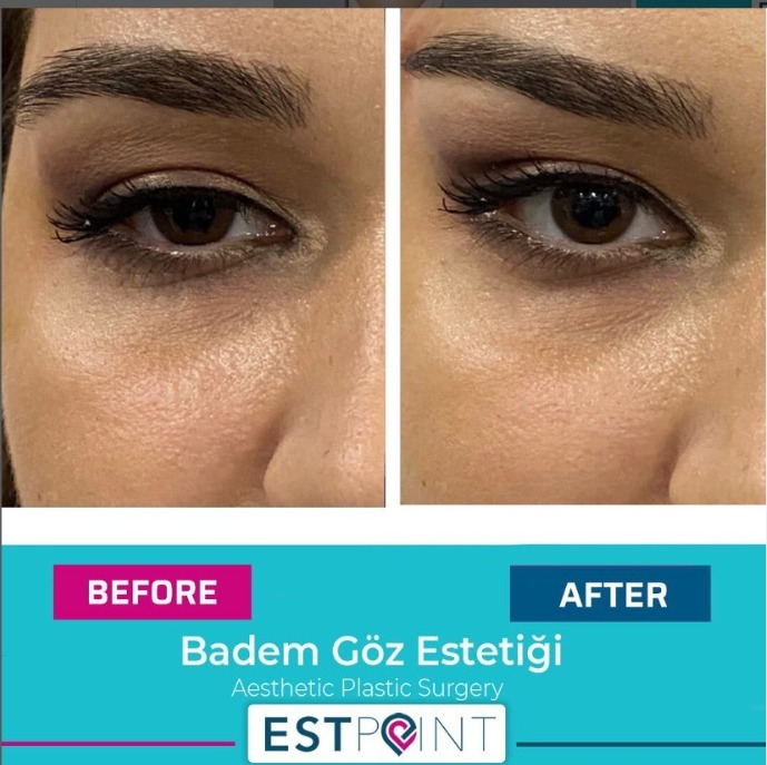 Badem Göz Ameliyatı Öncesi Sonrası